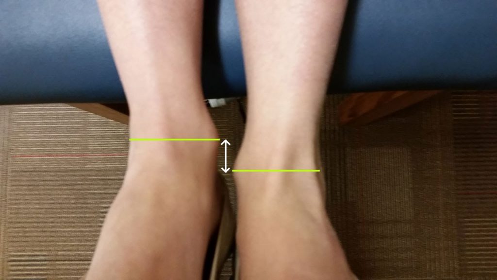 leg length discrepancy symptoms