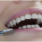 Getting Your Dental Veneers Done – Things to Know